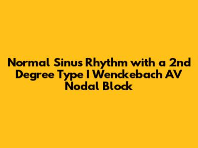 Normal Sinus Rhythm with a 2nd Degree Type I Wenckebach AV Nodal Block